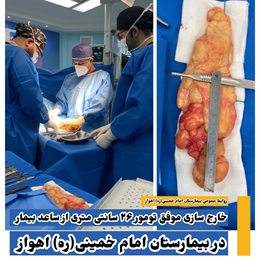 خارجسازی موفق تومور ۲۶ سانتیمتری از ساعد بیمار در بیمارستان امام خمینی(ره) اهواز